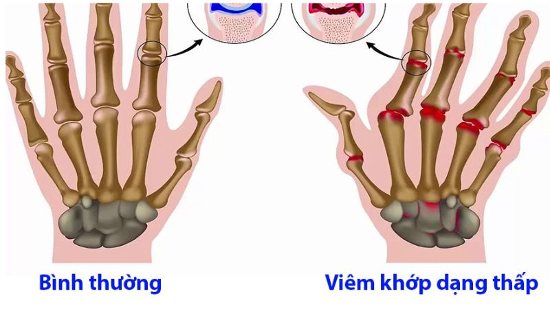 nuoc-hydrogen-giam-viem-khop-dang-thap